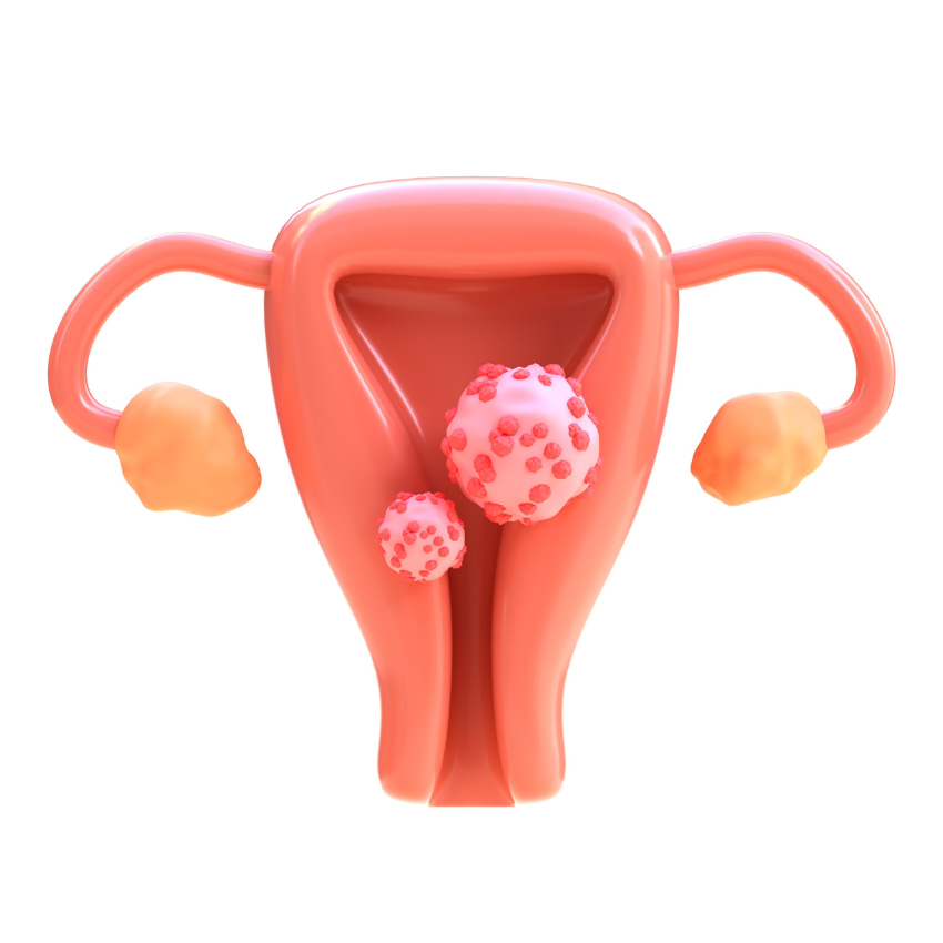 Tratamiento de fertilidad por miomas uterinos Queretaro